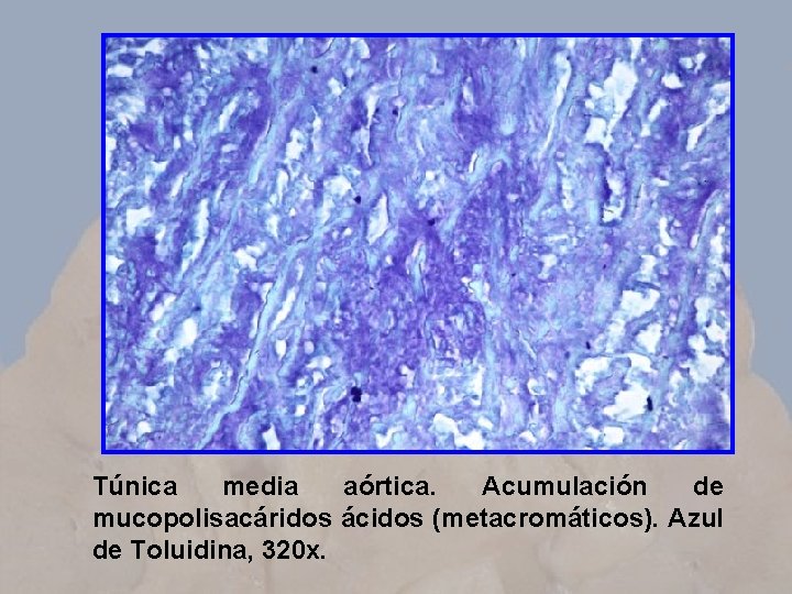 Túnica media aórtica. Acumulación de mucopolisacáridos ácidos (metacromáticos). Azul de Toluidina, 320 x. 