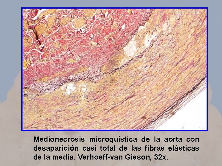 Medionecrosis microquística de la aorta con desaparición casi total de las fibras elásticas de