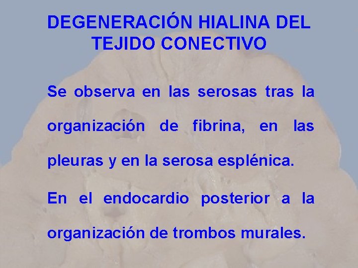 DEGENERACIÓN HIALINA DEL TEJIDO CONECTIVO Se observa en las serosas tras la organización de
