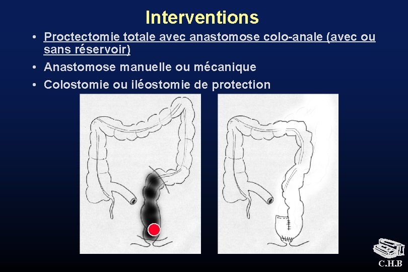 Interventions • Proctectomie totale avec anastomose colo-anale (avec ou sans réservoir) • Anastomose manuelle