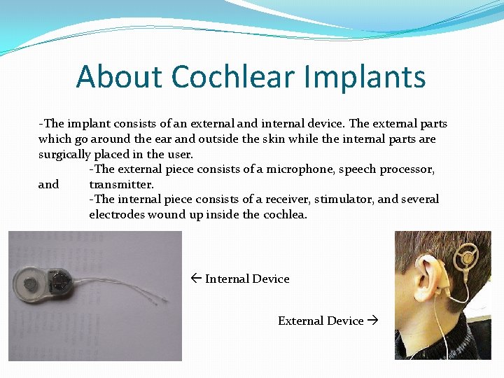 About Cochlear Implants -The implant consists of an external and internal device. The external