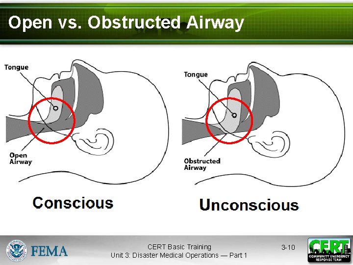 Open vs. Obstructed Airway CERT Basic Training Unit 3: Disaster Medical Operations — Part