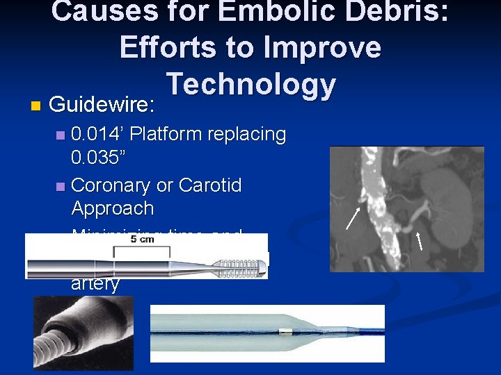 n Causes for Embolic Debris: Efforts to Improve Technology Guidewire: 0. 014’ Platform replacing