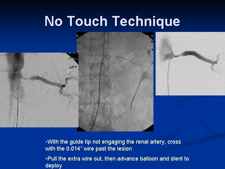 No Touch Technique • With the guide tip not engaging the renal artery, cross