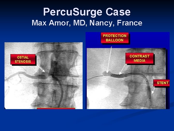 Percu. Surge Case Max Amor, MD, Nancy, France 