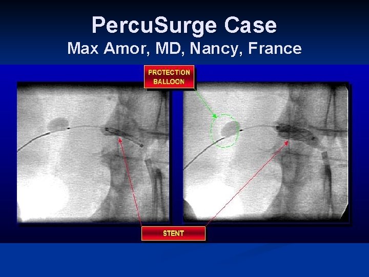 Percu. Surge Case Max Amor, MD, Nancy, France 