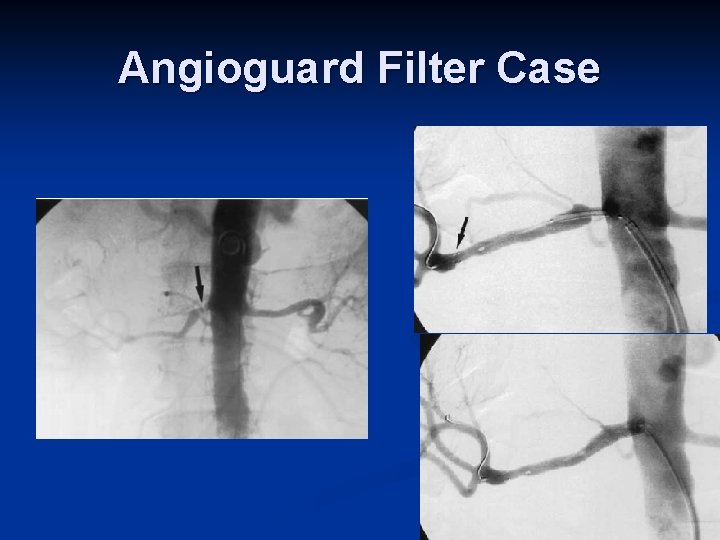 Angioguard Filter Case 