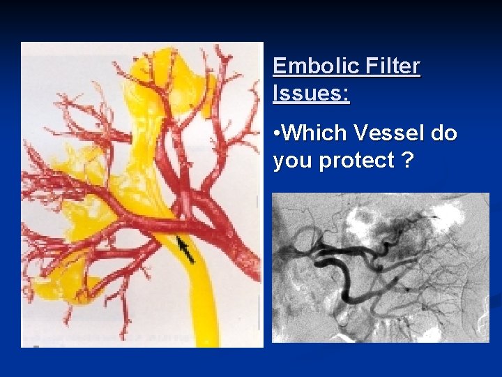 Embolic Filter Issues: • Which Vessel do you protect ? 