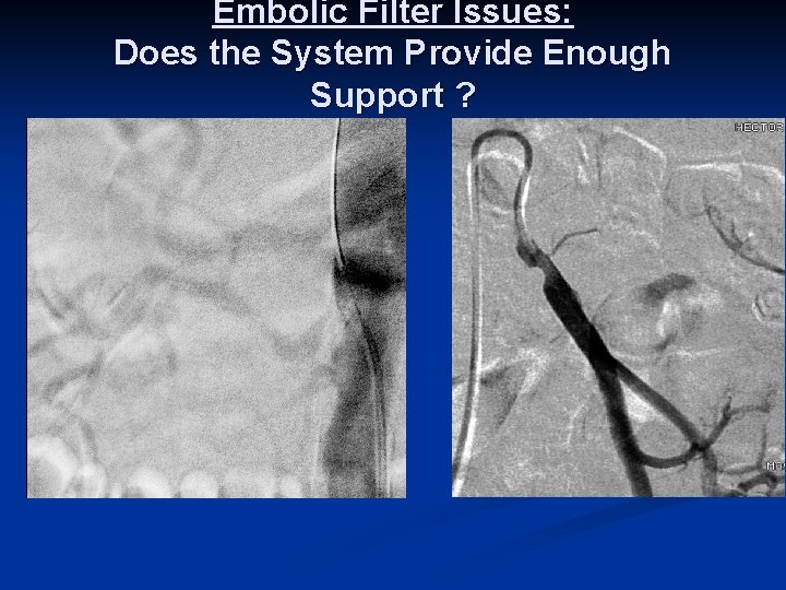 Embolic Filter Issues: Does the System Provide Enough Support ? 