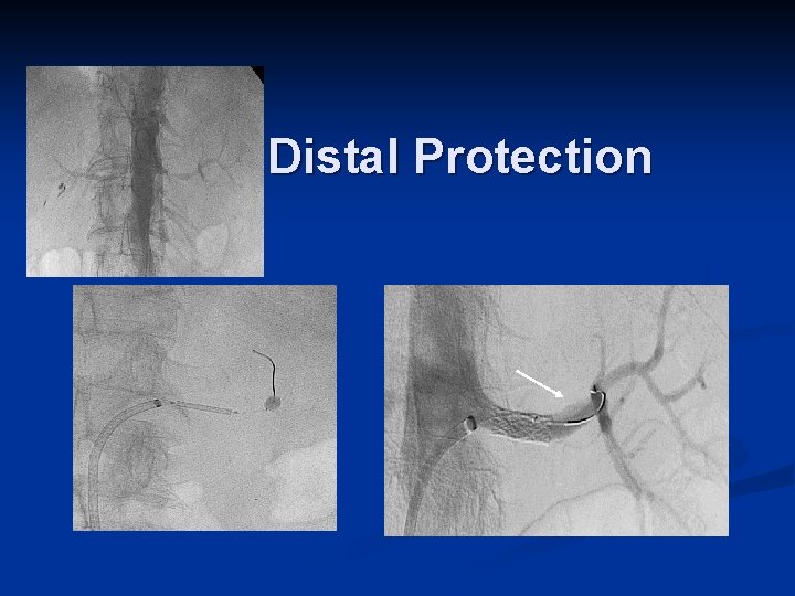 Distal Protection 