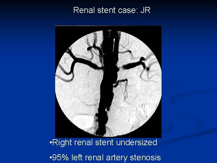 Renal stent case: JR • Right renal stent undersized • 95% left renal artery