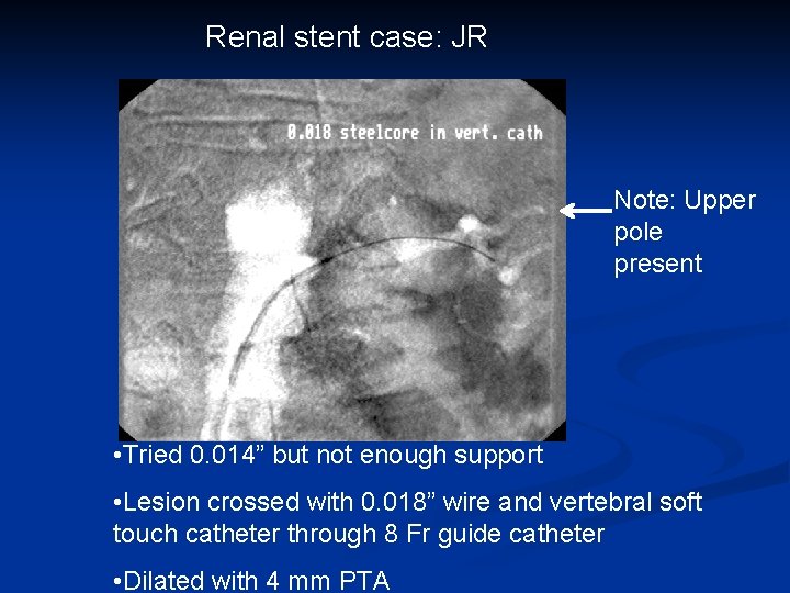 Renal stent case: JR Note: Upper pole present • Tried 0. 014” but not