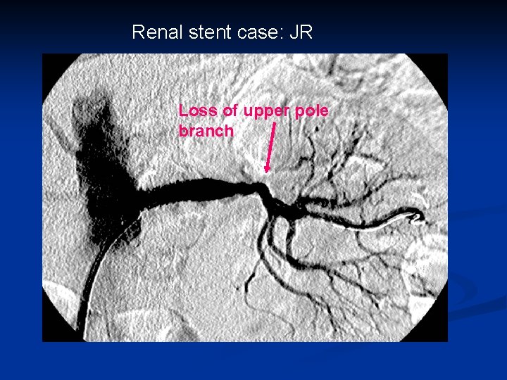 Renal stent case: JR Loss of upper pole branch 