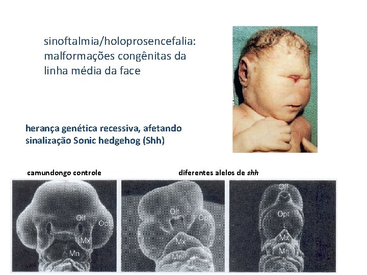 sinoftalmia/holoprosencefalia: malformações congênitas da linha média da face herança genética recessiva, afetando sinalização Sonic