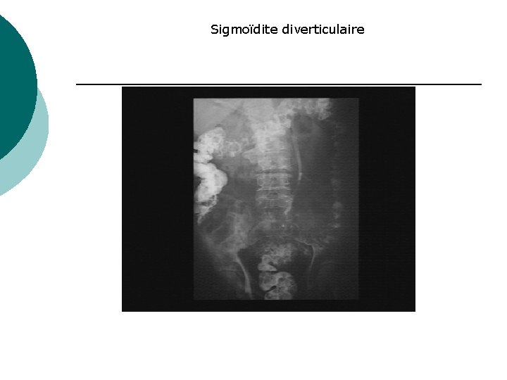 Sigmoïdite diverticulaire 
