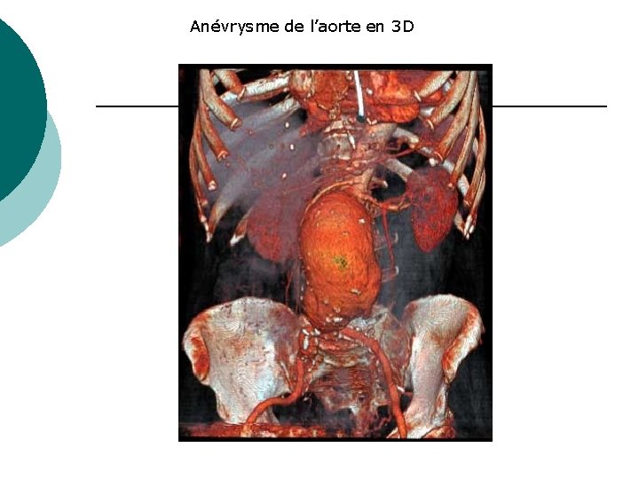 Anévrysme de l’aorte en 3 D 