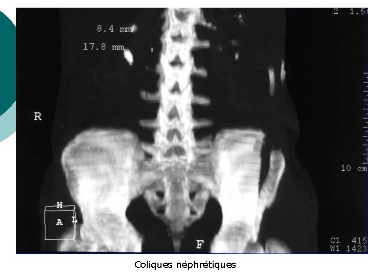 Coliques néphrétiques 