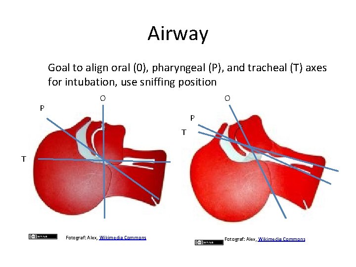 Airway Goal to align oral (0), pharyngeal (P), and tracheal (T) axes for intubation, Airway Goal to align oral (0), pharyngeal (P), and tracheal (T) axes for intubation,