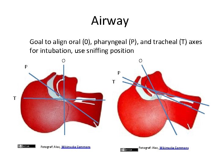 Airway Goal to align oral (0), pharyngeal (P), and tracheal (T) axes for intubation,