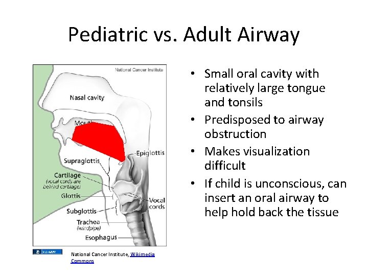Pediatric vs. Adult Airway • Small oral cavity with relatively large tongue and tonsils