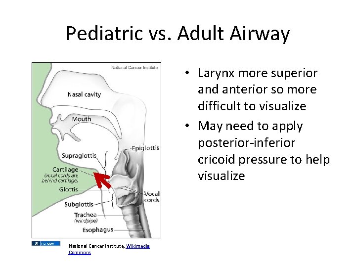 Pediatric vs. Adult Airway • Larynx more superior and anterior so more difficult to