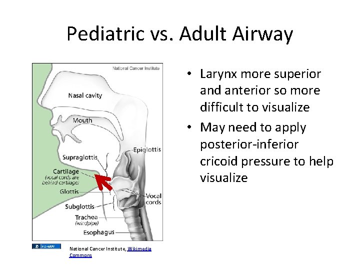 Pediatric vs. Adult Airway • Larynx more superior and anterior so more difficult to Pediatric vs. Adult Airway • Larynx more superior and anterior so more difficult to