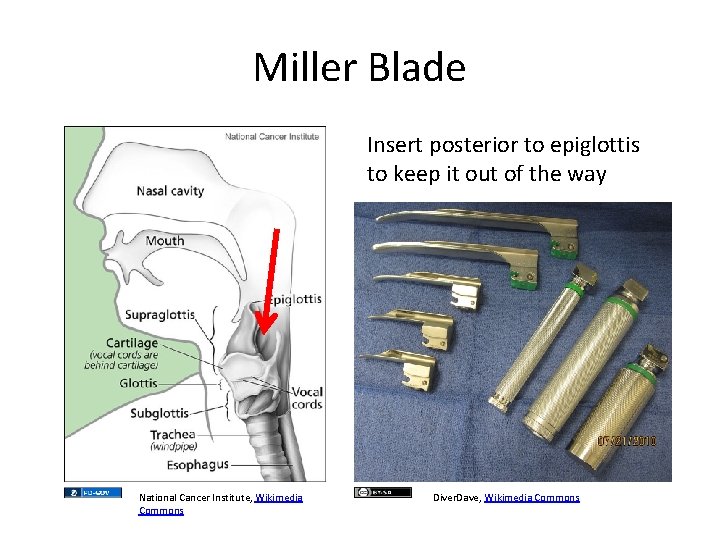 Miller Blade Insert posterior to epiglottis to keep it out of the way National