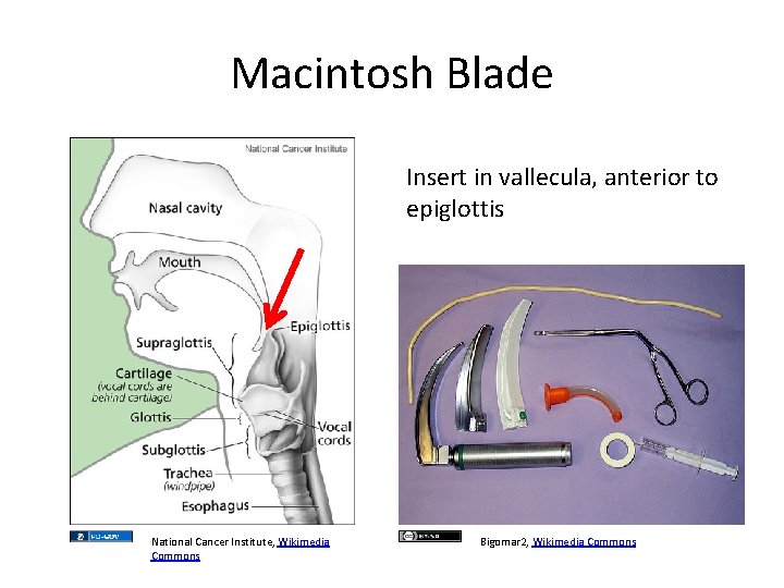 Macintosh Blade Insert in vallecula, anterior to epiglottis National Cancer Institute, Wikimedia Commons Bigomar