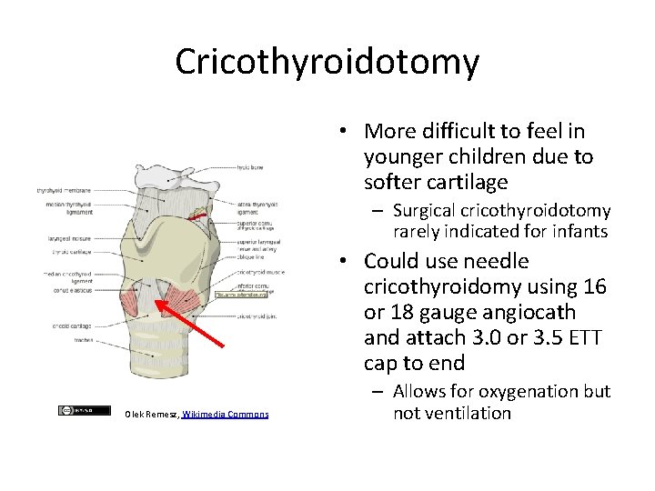 Cricothyroidotomy • More difficult to feel in younger children due to softer cartilage –