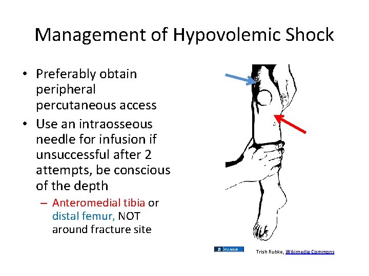 Management of Hypovolemic Shock • Preferably obtain peripheral percutaneous access • Use an intraosseous