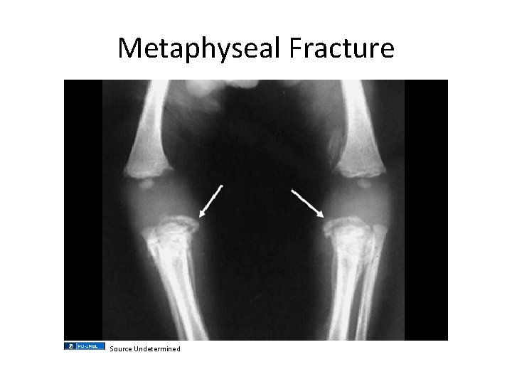 Metaphyseal Fracture Source Undetermined 