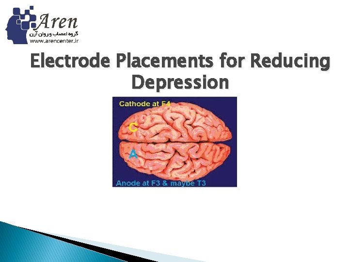 Electrode Placements for Reducing Depression 