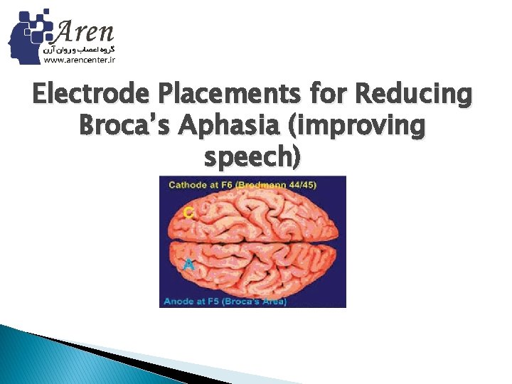 Electrode Placements for Reducing Broca’s Aphasia (improving speech) 
