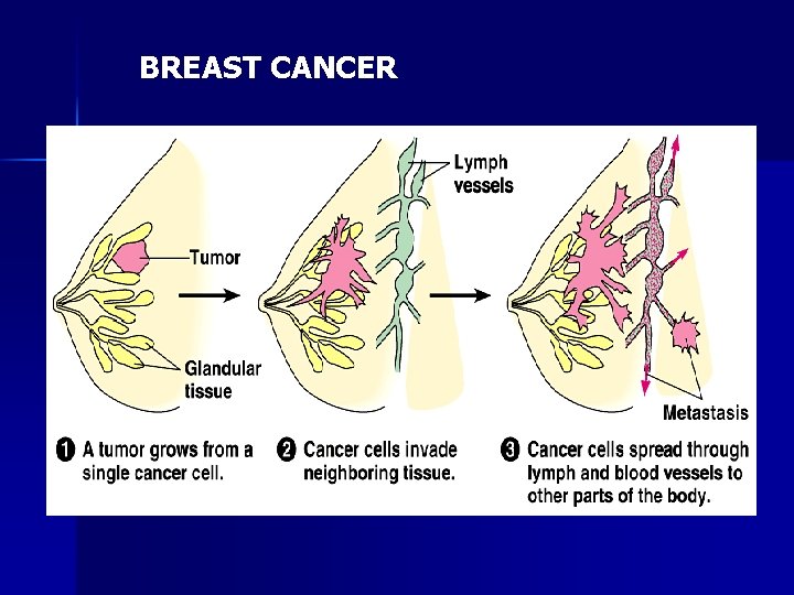 BREAST CANCER 