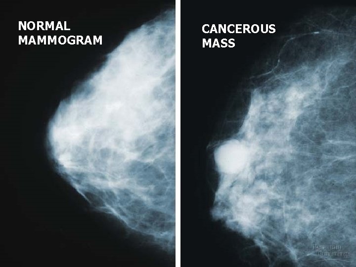 n NORMAL MAMMOGRAM CANCEROUS MASS 