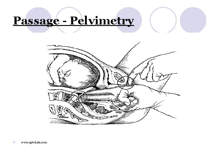 Passage - Pelvimetry l www. uptodate. com 