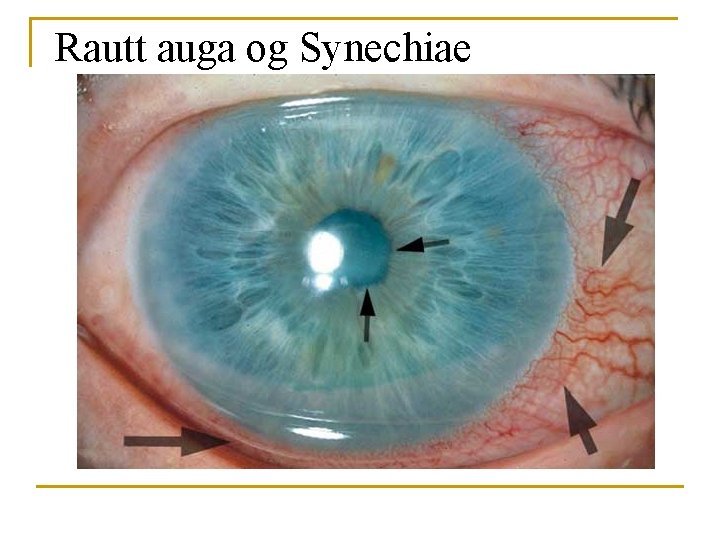 Rautt auga og Synechiae 