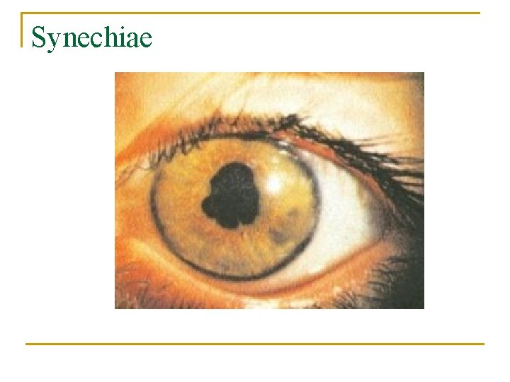 Synechiae 