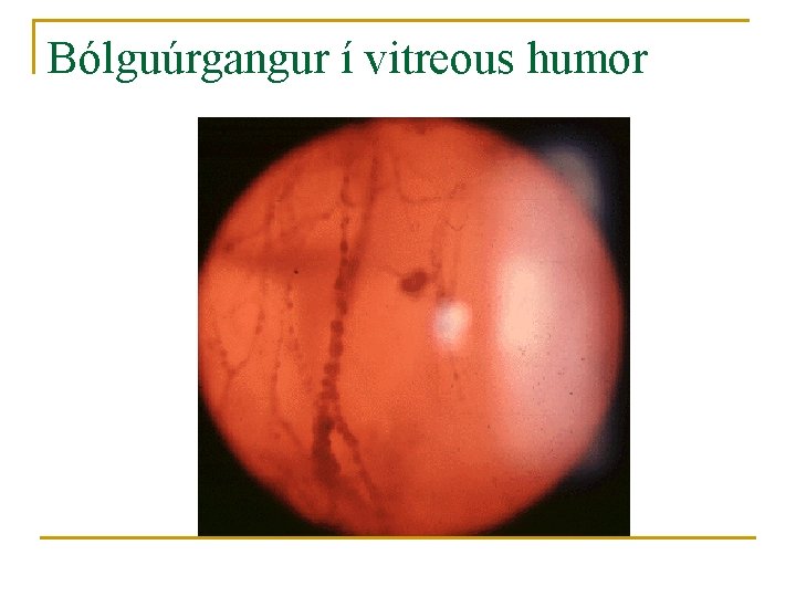 Bólguúrgangur í vitreous humor 