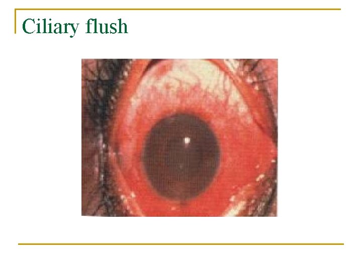 Ciliary flush 