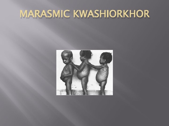 MARASMIC KWASHIORKHOR 