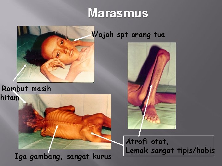 Marasmus Wajah spt orang tua Rambut masih hitam Iga gambang, sangat kurus Atrofi otot,