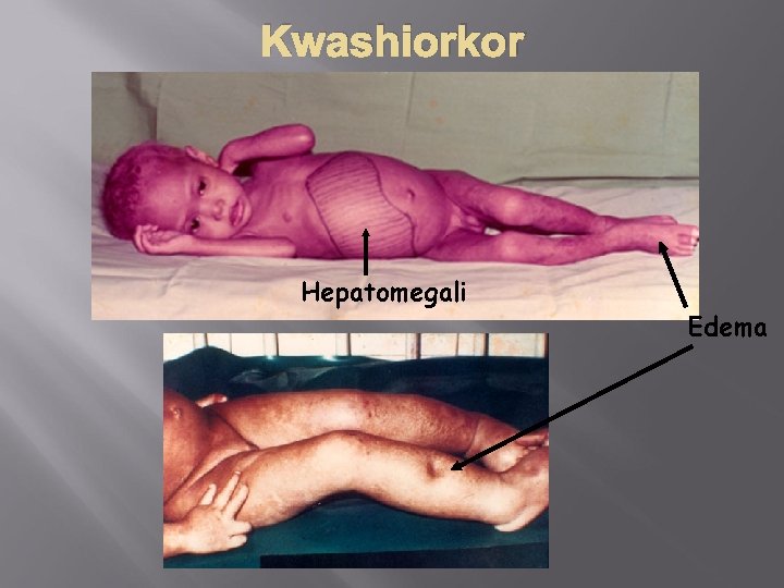 Kwashiorkor Hepatomegali Edema 