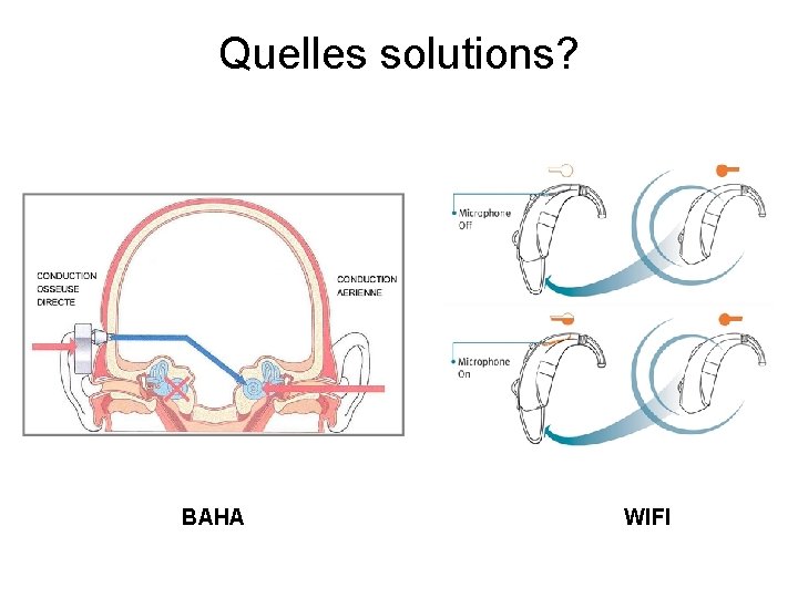 Quelles solutions? BAHA WIFI 