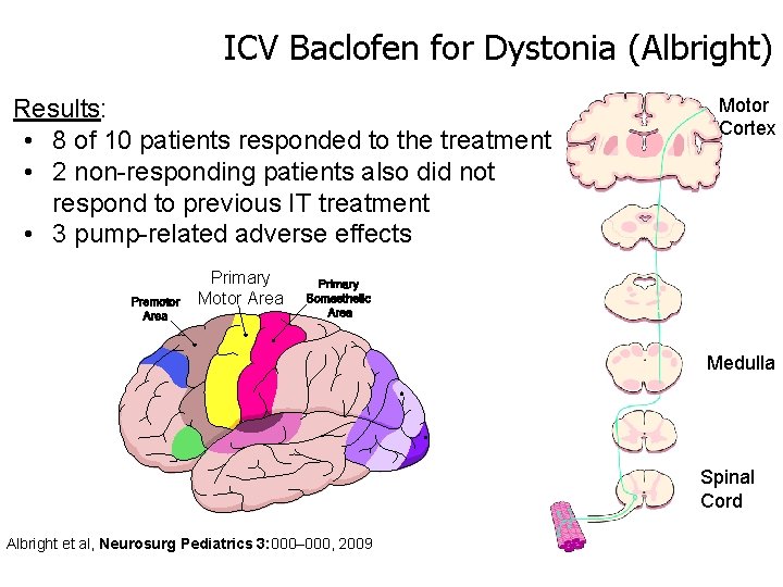 ICV Baclofen for Dystonia (Albright) Results: • 8 of 10 patients responded to the