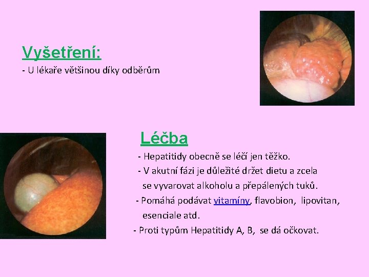 Vyšetření: - U lékaře většinou díky odběrům Léčba - Hepatitidy obecně se léčí jen