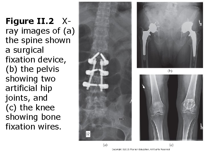 Figure II. 2 Xray images of (a) the spine shown a surgical fixation device,