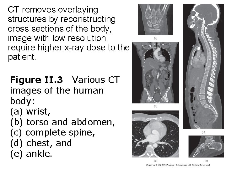CT removes overlaying structures by reconstructing cross sections of the body, image with low