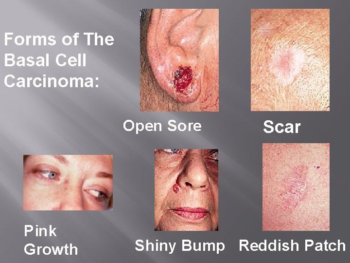 Forms of The Basal Cell Carcinoma: Open Sore Pink Growth Scar Shiny Bump Reddish