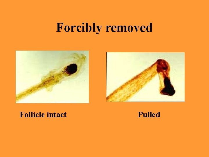 Forcibly removed Follicle intact Pulled 